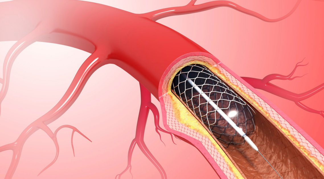 Heart Ring Price and Surgery Procedure Cost in Bangladesh