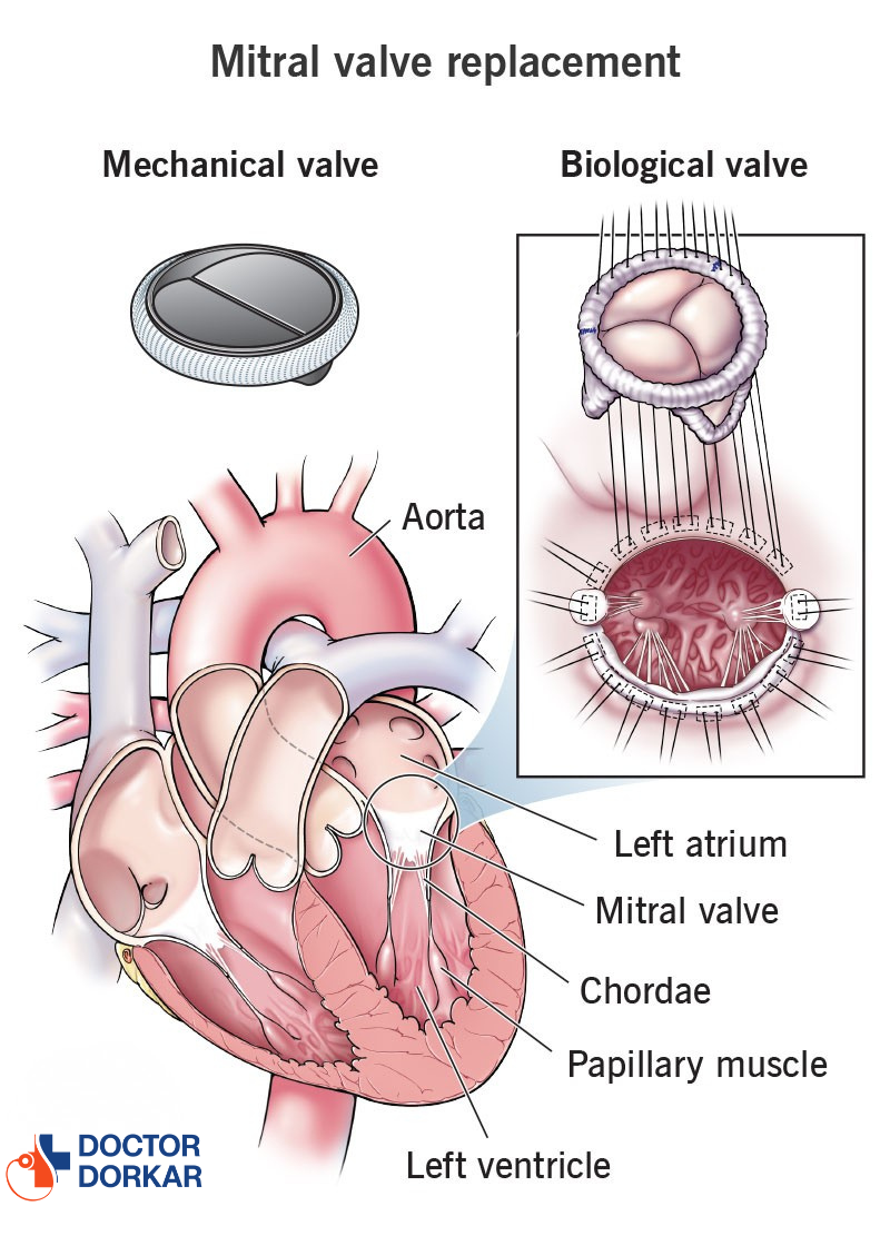 Mitral Valve Replacement of a Middle-aged Woman