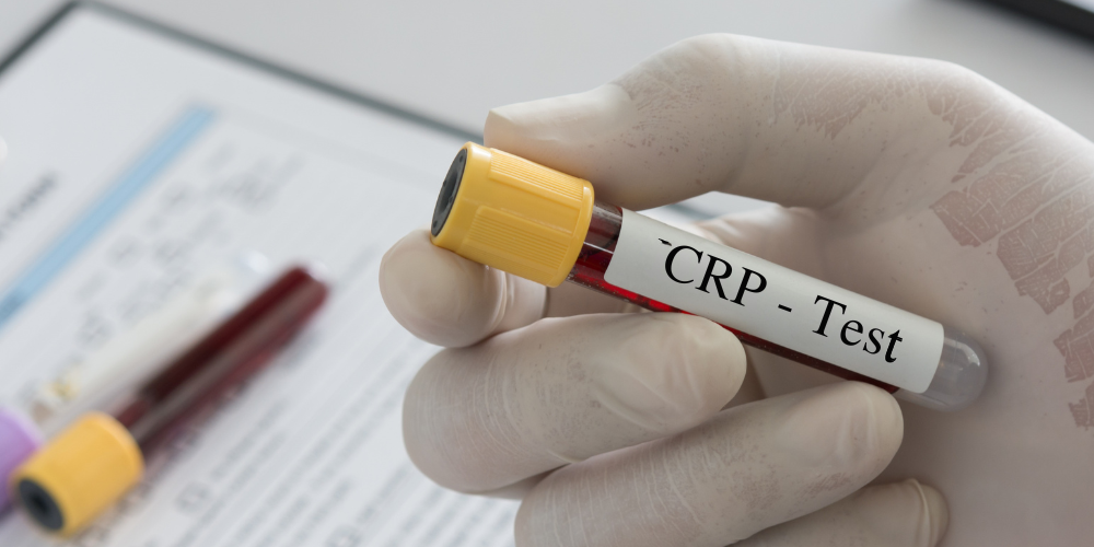 CRP Test Price in Bangladesh 2026: Latest Cost, Types & Diagnostic Centers